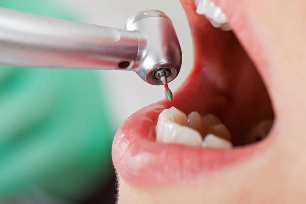 Best Emergency Wisdom Teeth Removal in Batesburg Leesville, SC